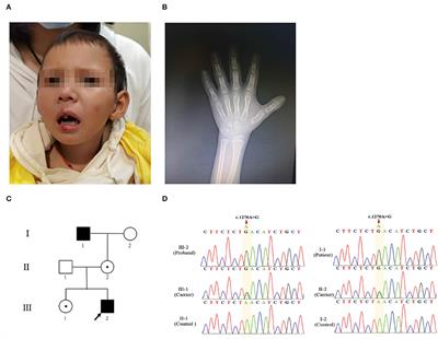 FGD1 Variant Associated With Aarskog–Scott Syndrome